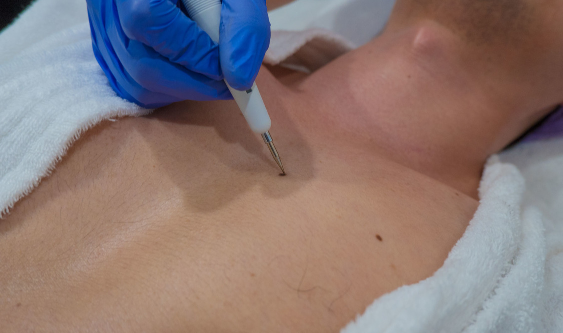 Whole Body Warts Removal