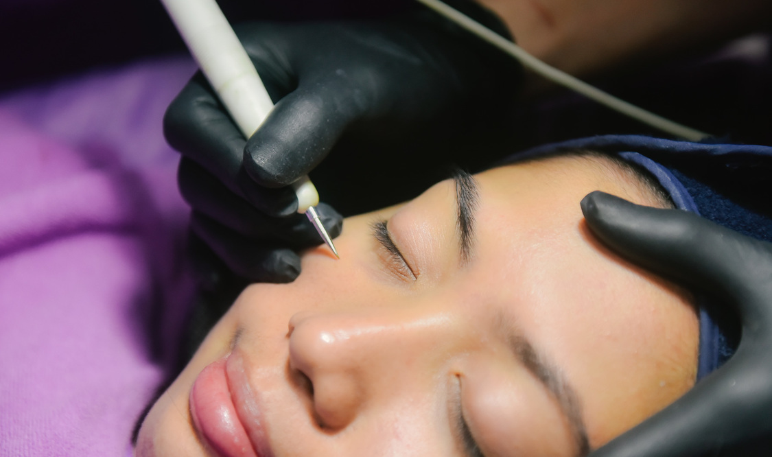 Warts Removal